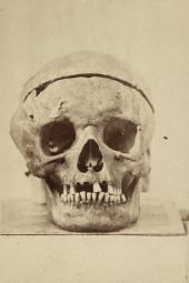 Schädel Ludwig van Beethovens bei der ersten Exhumierung, J.B. Rottmayer, Fotografie, 1863